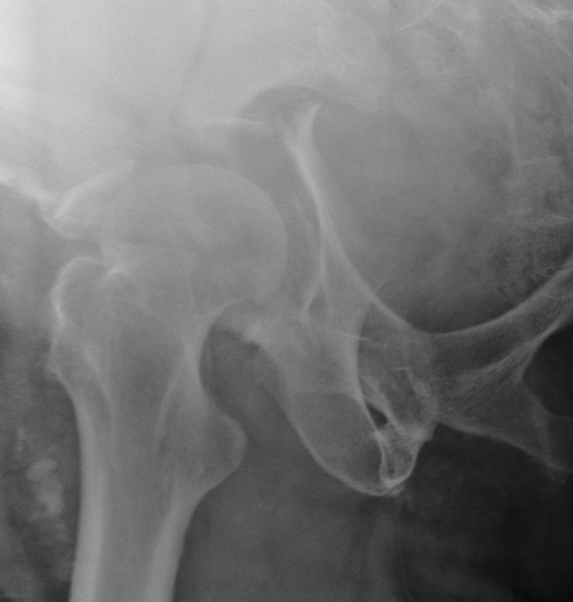 Acetabular Fracture Judet View
